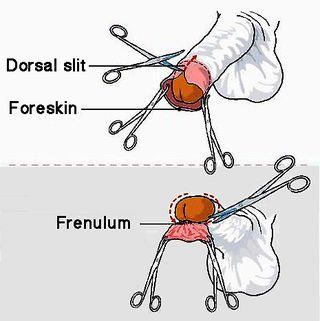 Porsche reccomend foreskin restoration exercises provide larger