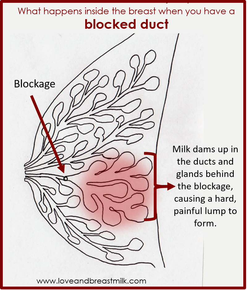 Thunderbird reccomend unclogging blocked milk ducts