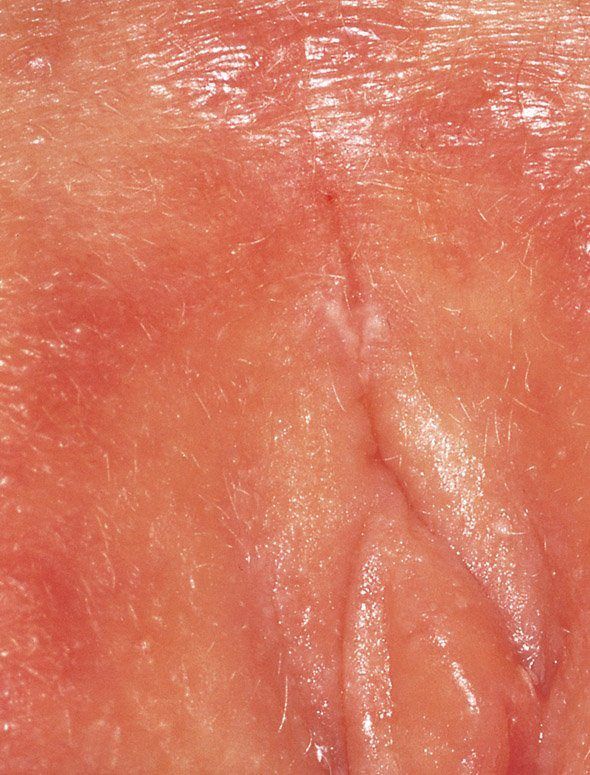 Rocker reccomend Torn skin below anus