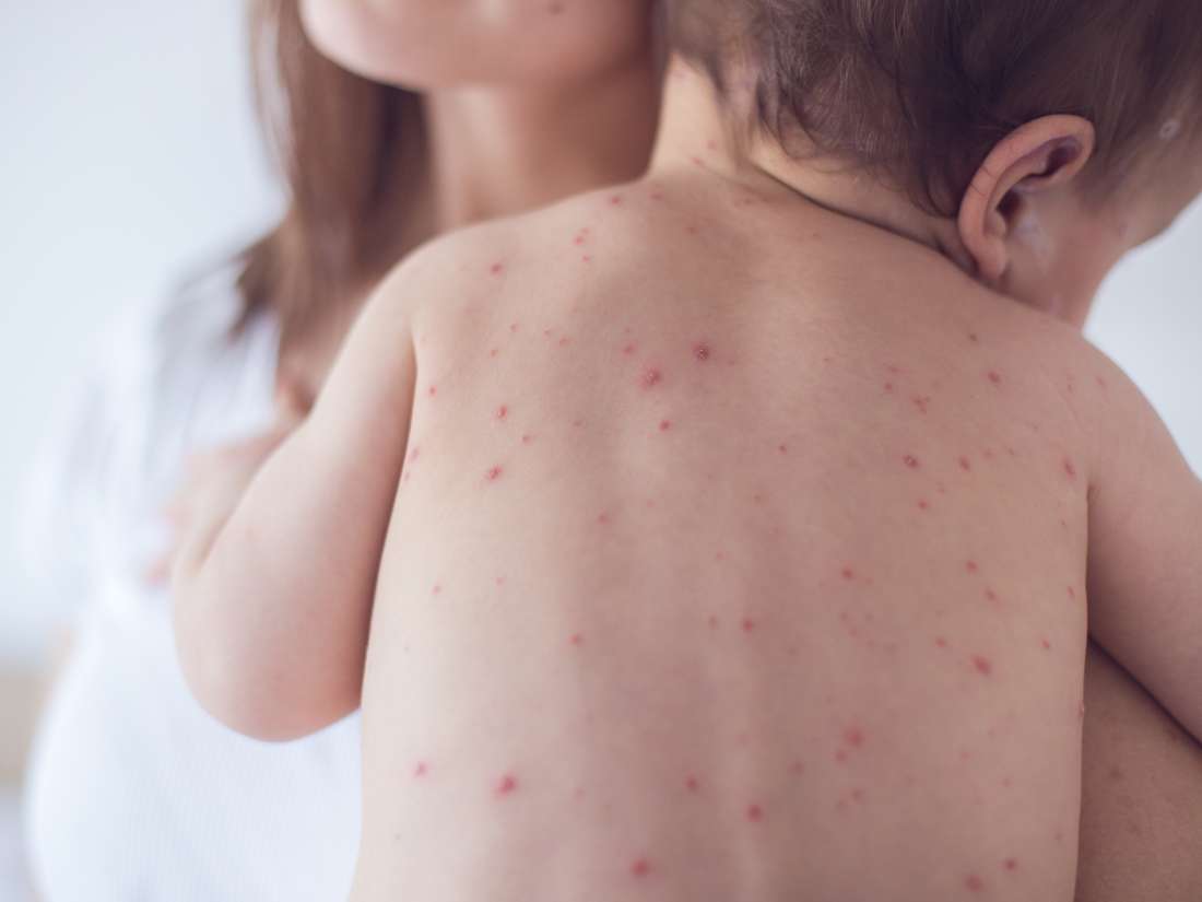 best of Measles in adults Fake