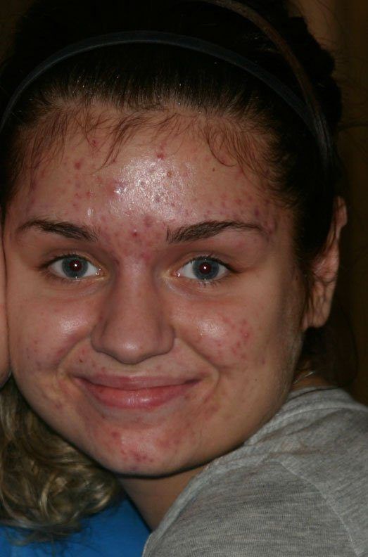 best of Her pimples on Sperm