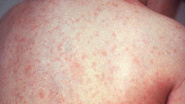 best of Measles in adults Fake