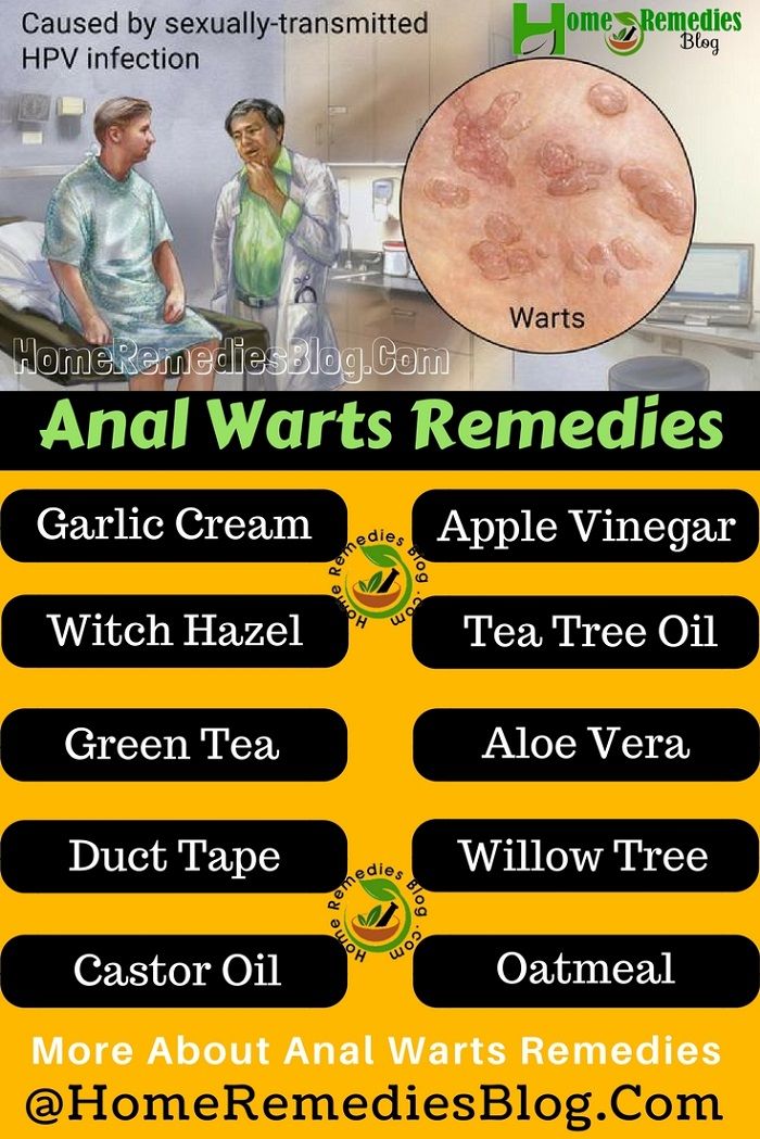 Anal warts homeopathic remedy