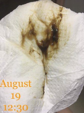 Brown jelly discharge from vagina