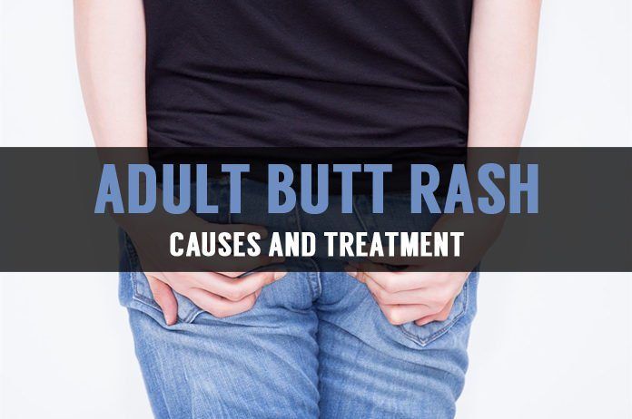 Adult butt rash