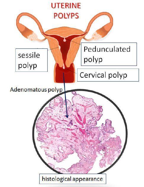 best of Vagina polyp Epithelial