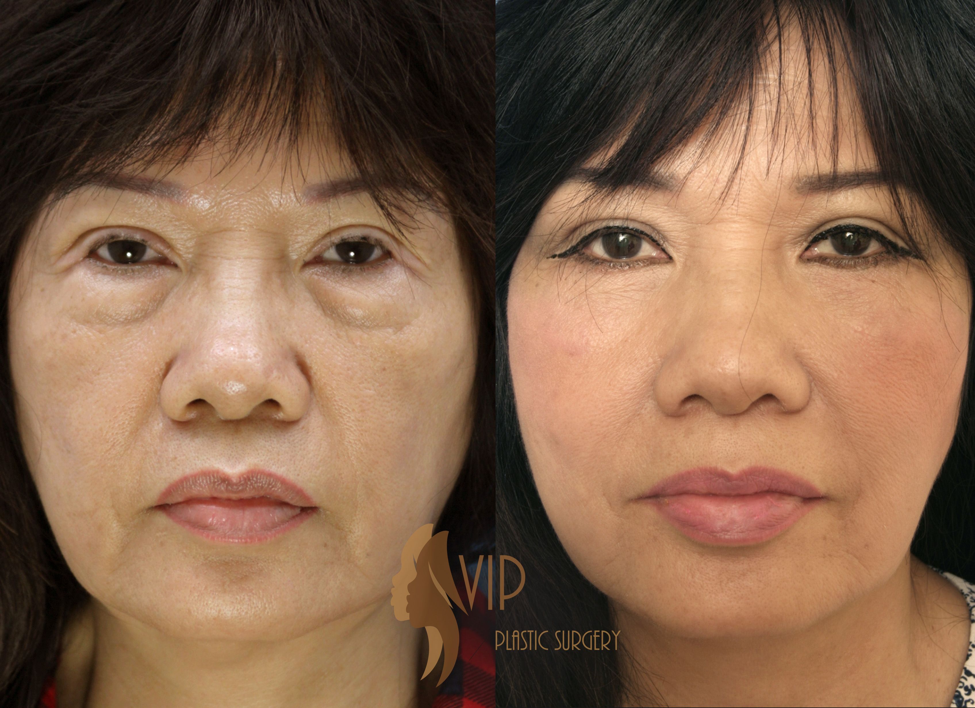 best of Plastic surgery facial Cadillac