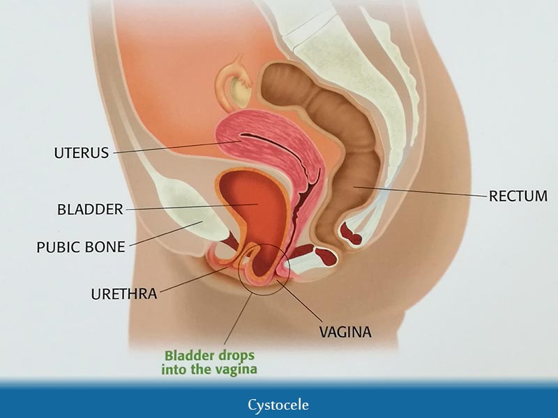 Dorothy reccomend Large lump between vagina and anus