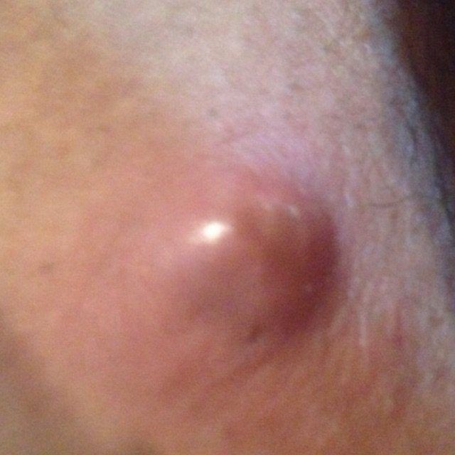 best of Vulva Pimple