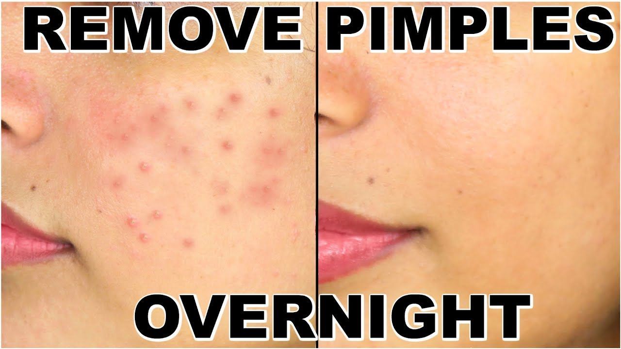 Dahlia reccomend Home remedies for red pimples on face