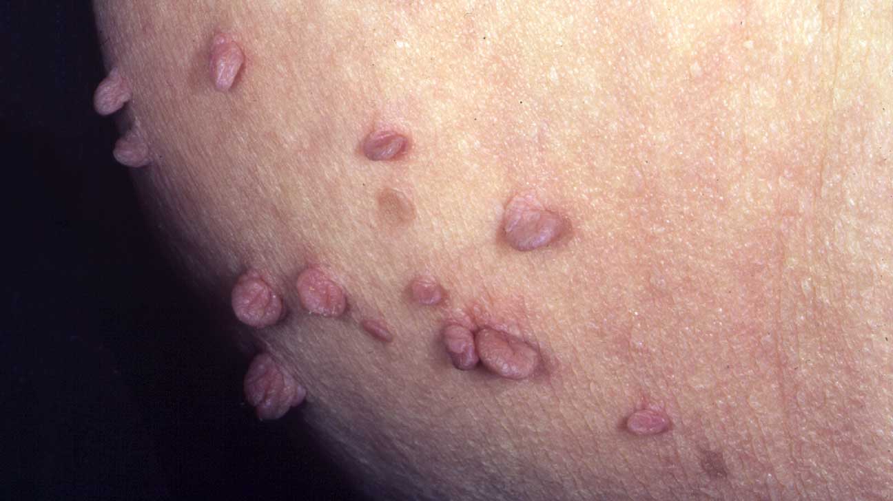 Cluster of bumps on vagina