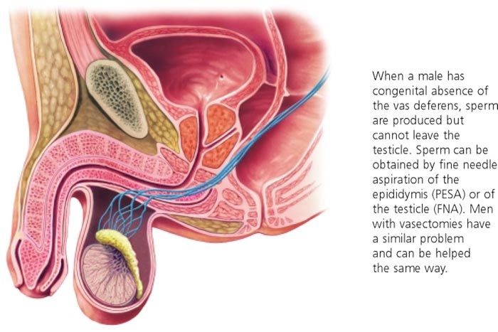 best of Vasectomy injection Intracytoplasmic sperm