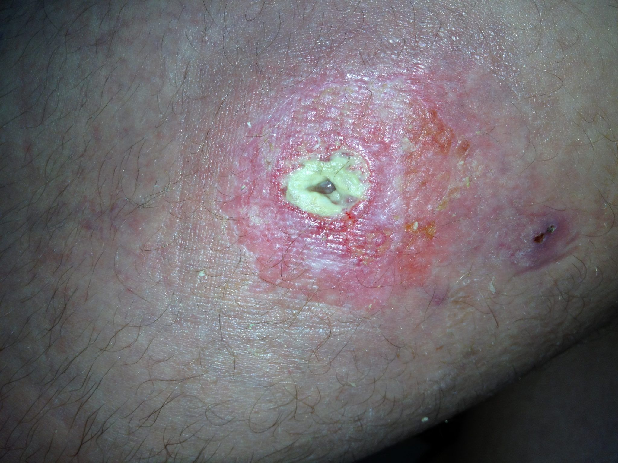 best of Pimples holes Dirty ass
