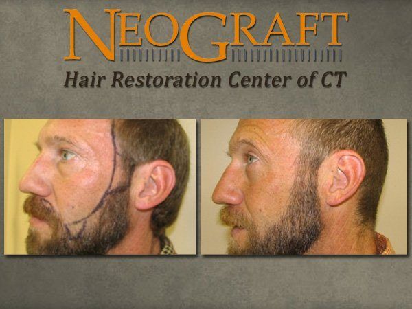 best of Hair restoration Facial