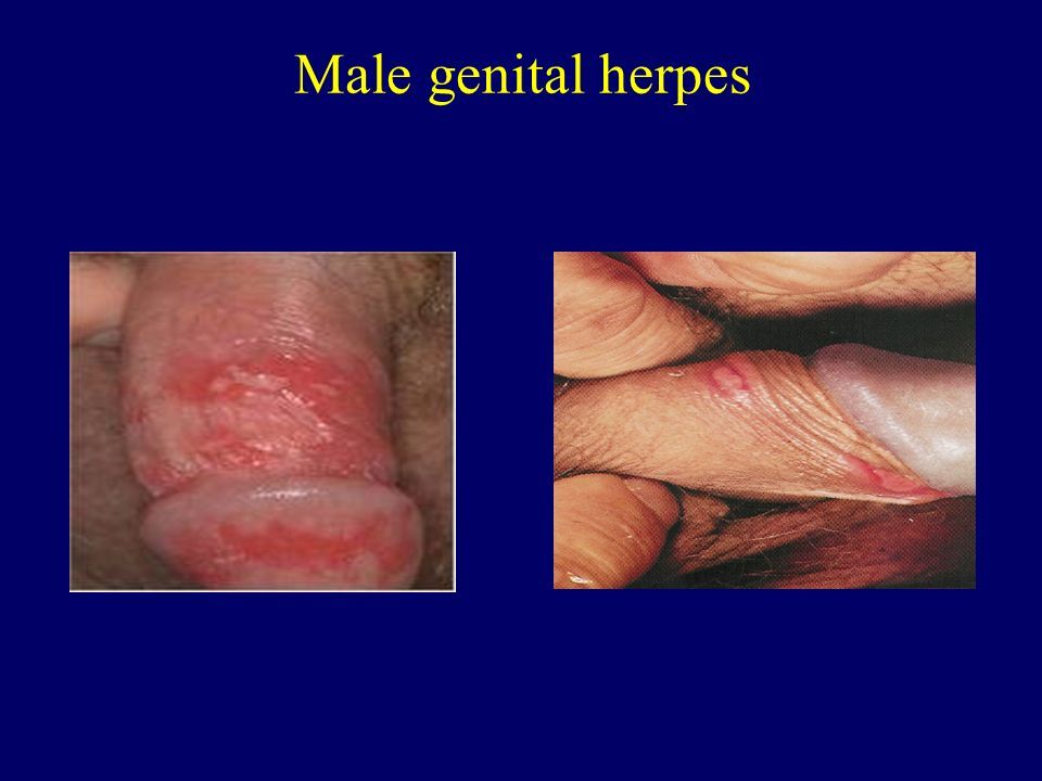 Genitals herpes pictures in men mild