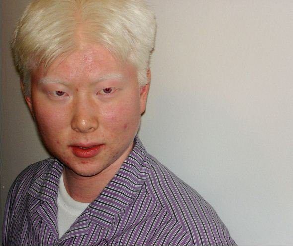 best of Down syndrome midget Albino