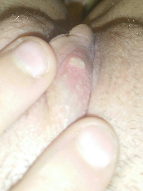 Winter reccomend White bumps around clitoris