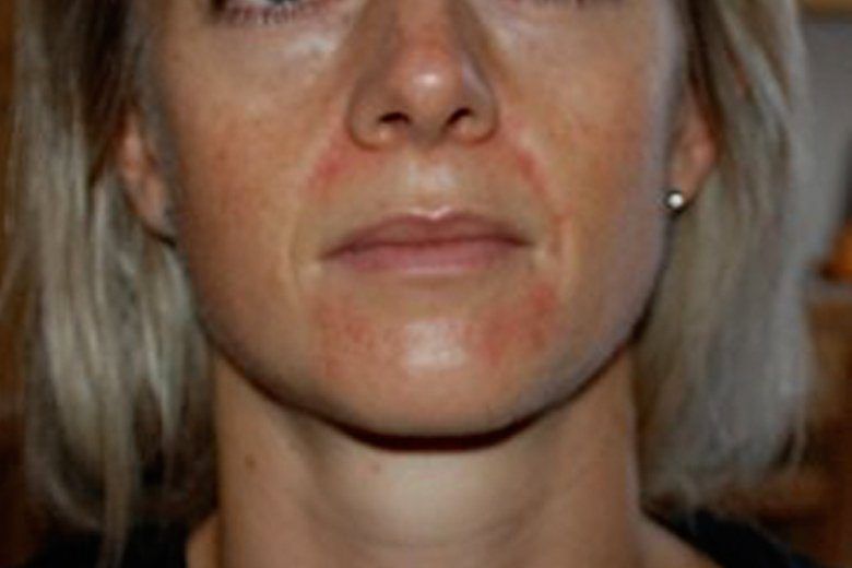 Facial yeast dermatitis