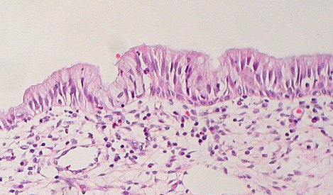 Epithelial vagina polyp