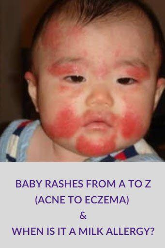 Sugar P. reccomend Infant facial rashes