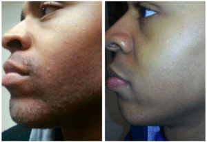 best of Of results laser removal facial Pictures hair