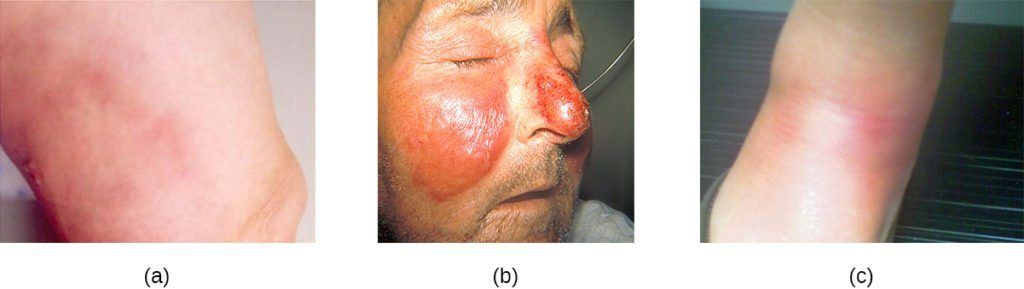 best of Staph culture abcess growth Facial heavy