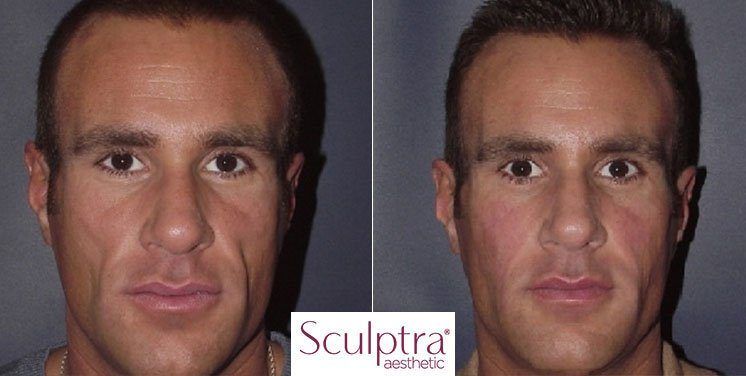 best of Fillers and pictures Facial