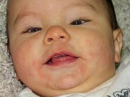 best of Facial rashes Infant