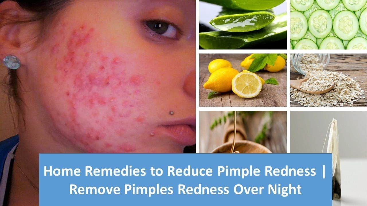 Home remedies for red pimples on face
