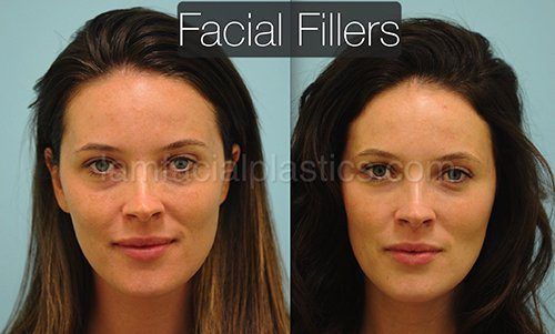 Moonshine reccomend Facial fillers and pictures
