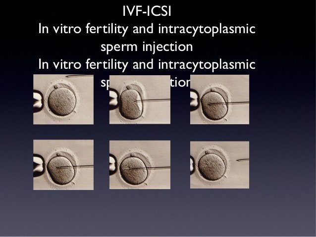 Intracytoplasmic sperm injection vasectomy