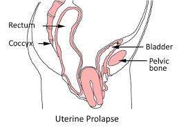 Large lump between vagina and anus
