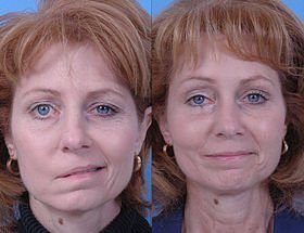 Facial reanimation surgery
