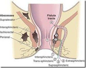 best of And crohns disease Anal fistulas
