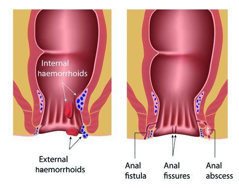 Anal fistulas and crohns disease