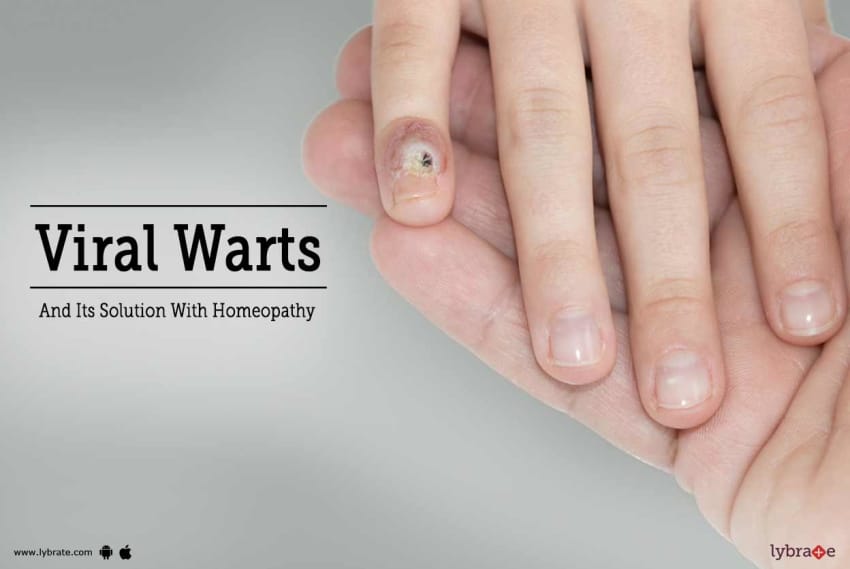 Anal warts homeopathic remedy