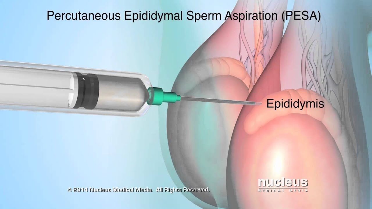 Aspiration and sperm and diagram