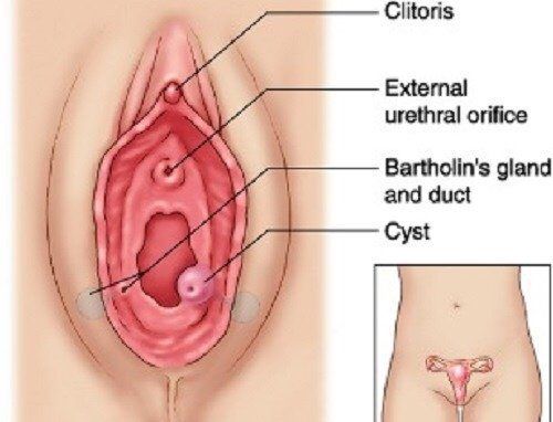 Bumps near opening of vagina