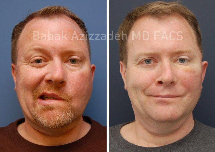 Beverly hills facial reconstruction surgery