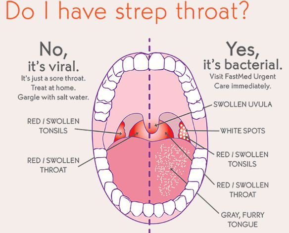 Can adults get strep throat