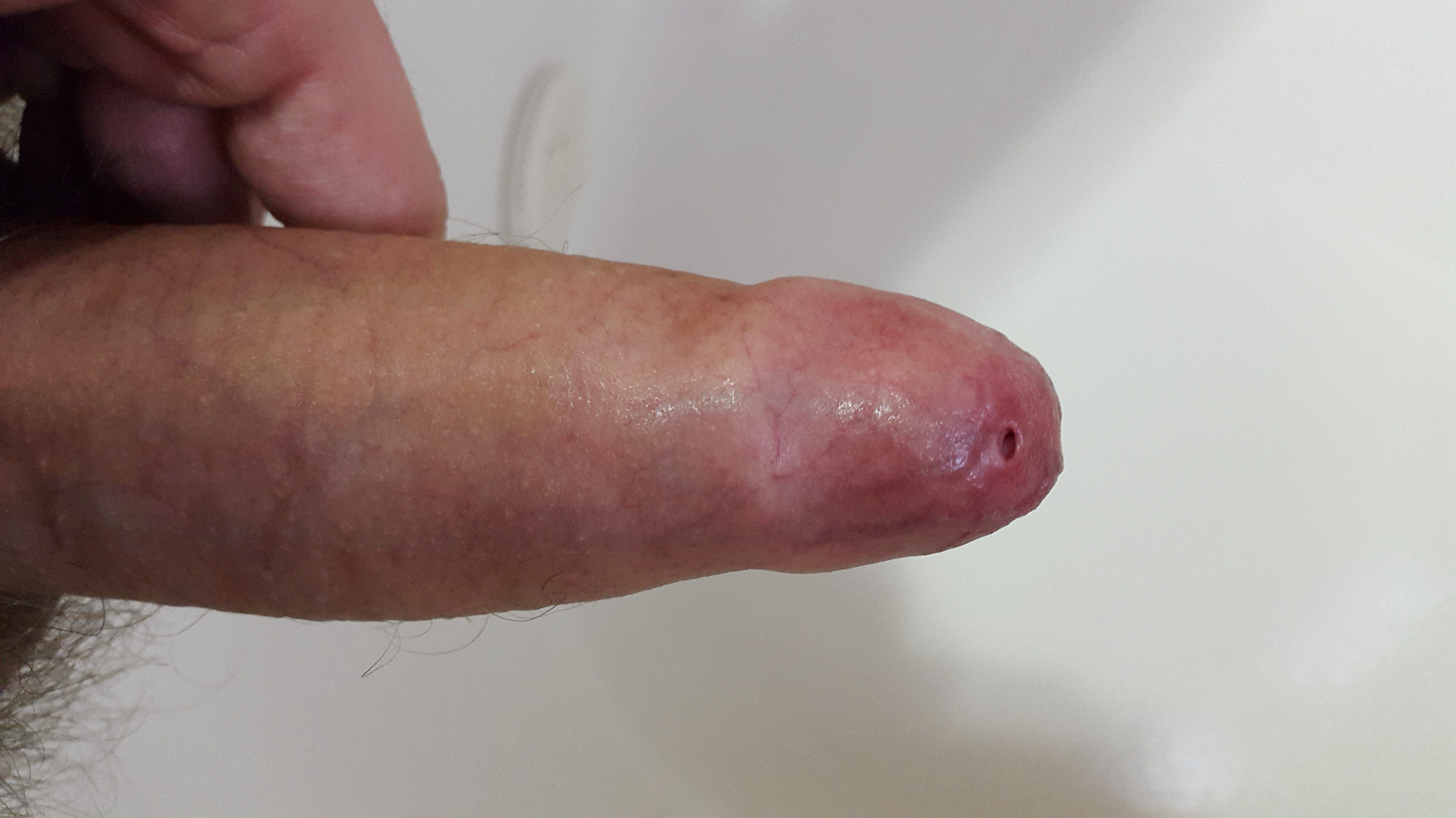 best of With Erect phimosis penis