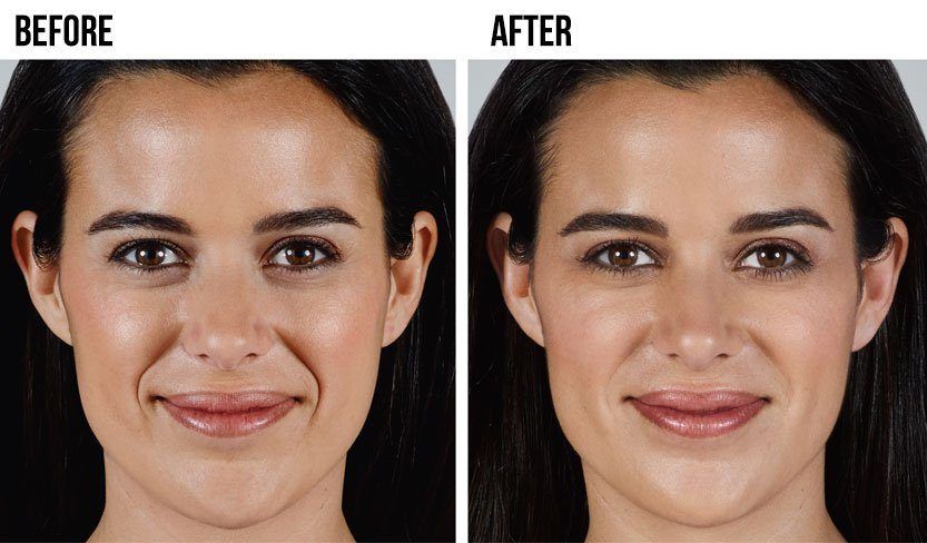 Facial fillers and pictures