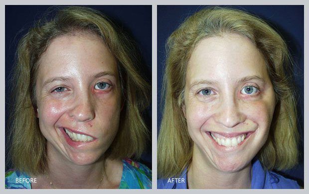 Defense reccomend Facial reanimation surgery