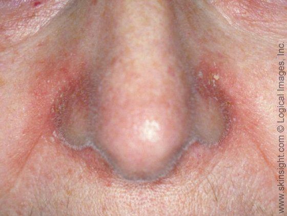 Sub reccomend Facial yeast dermatitis