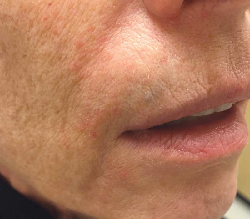best of Yeast dermatitis Facial