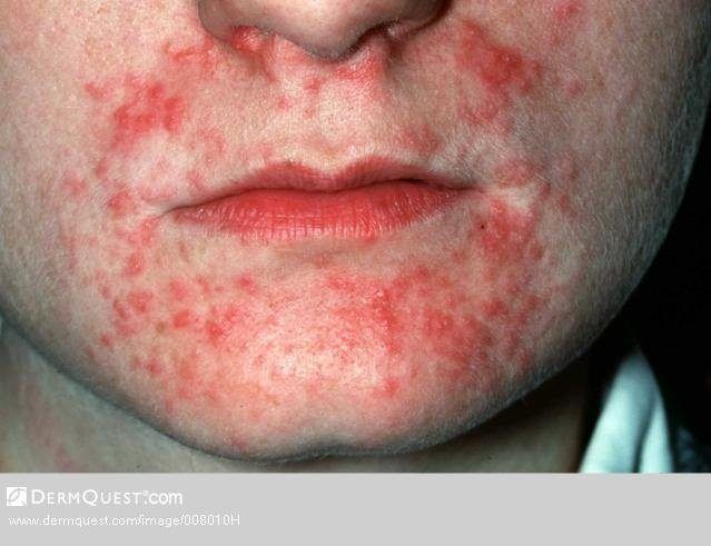 Facial yeast dermatitis