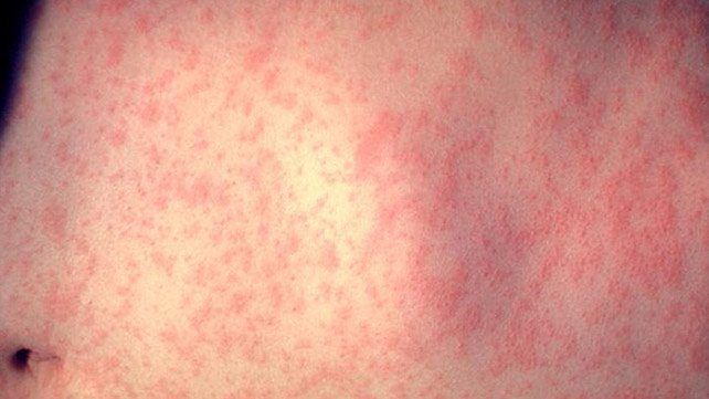 Fake measles in adults