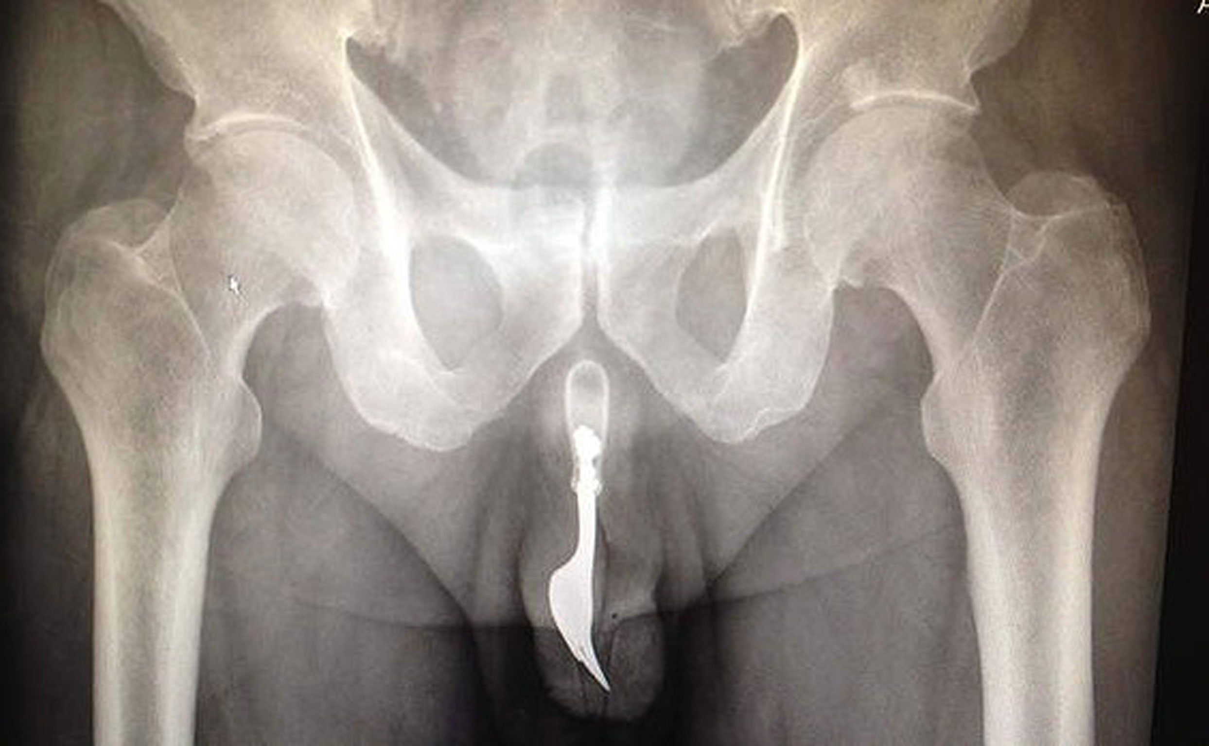 Giant penis urethras