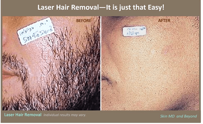 Pictures of facial laser hair removal results