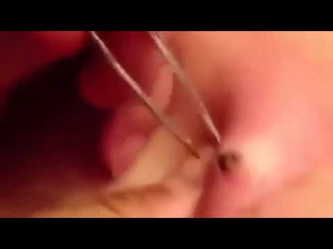 Pimple vulva